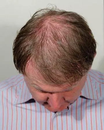   solutions before after mens gallery photos of mens hair loss 03 mens before and after photo 02