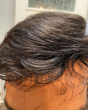   solutions before after mens gallery photos of mens hair loss 12 mens before and after photo 01