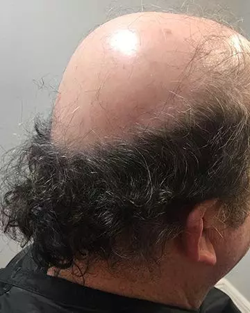   solutions before after mens gallery photos of mens hair loss 02 mens before and after photo 02