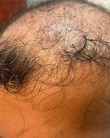 12 mens before and after photo 02 solutions before after mens gallery photos of mens hair loss 12 mens before and after photo 02