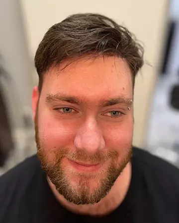 13 mens before and after photo 01 solutions before after mens gallery photos of mens hair loss 13 mens before and after photo 01