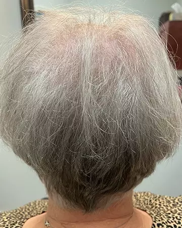 17 womens before and after photo 02 solutions before after womens gallery photos of womens hair loss 17 womens before and after photo 02