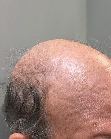   solutions before after mens gallery photos of mens hair loss 01 mens before and after photo 02