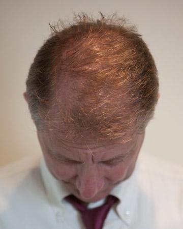   solutions before after mens gallery photos of mens hair loss 04 mens before and after photo 02