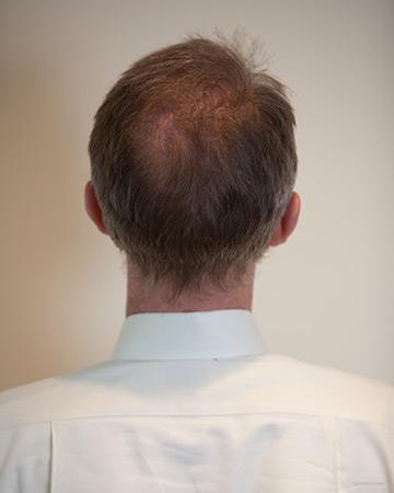   solutions before after mens gallery photos of mens hair loss 06 mens before and after photo 02