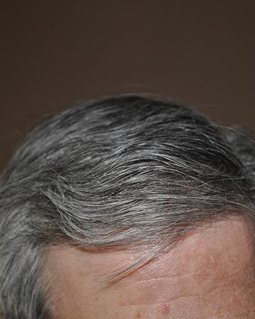   solutions before after mens gallery photos of mens hair loss 09 mens before and after photo 01