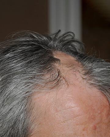   solutions before after mens gallery photos of mens hair loss 09 mens before and after photo 02