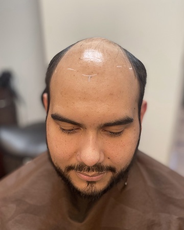  solutions before after mens gallery photos of mens hair loss 10 mens before and after photo 02