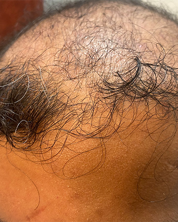 12 mens before and after photo 02 solutions before after mens gallery photos of mens hair loss 12 mens before and after photo 02