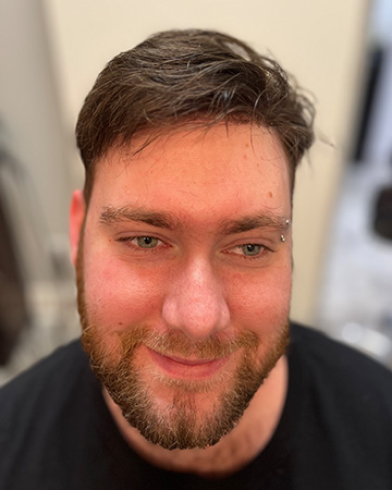 13 mens before and after photo 01 solutions before after mens gallery photos of mens hair loss 13 mens before and after photo 01