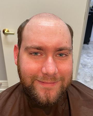 13 mens before and after photo 02 solutions before after mens gallery photos of mens hair loss 13 mens before and after photo 02