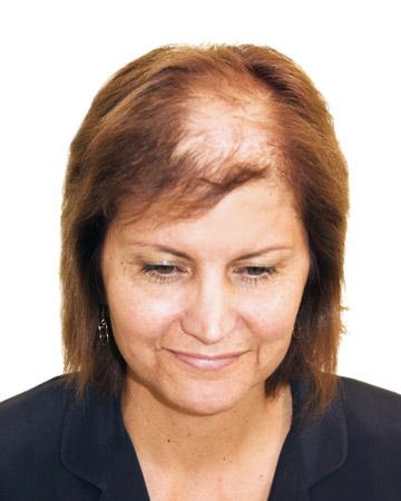   solutions before after womens gallery photos of womens hair loss 09 womens before and after photo 02