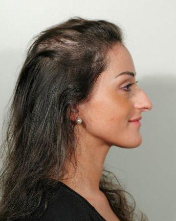   solutions before after womens gallery photos of womens hair loss 10 womens before and after photo 02